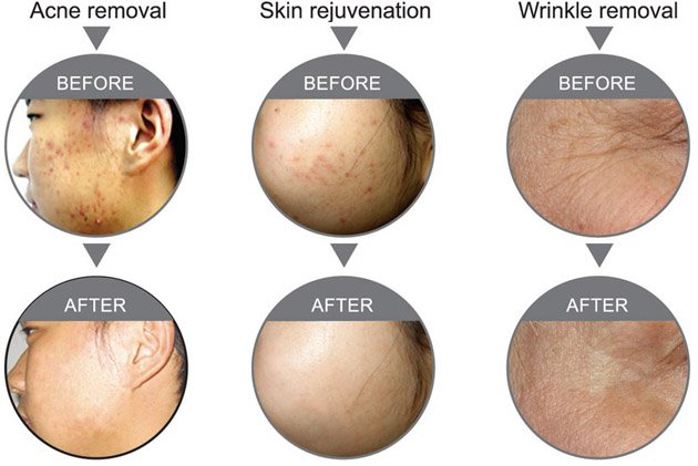 PDT Heimnutzung führte Hautverjüngung