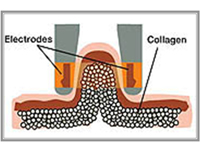 Cellulite-Hohlraumbildungs-Infrarotkörper, der Ausrüstung mit zweipoliger Rf-/LPG-Saugwalze formt